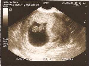 2mo4dayultrasound1-5-09.jpg